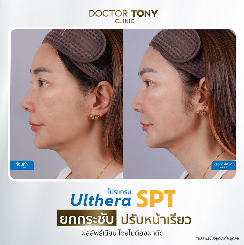 รีวิว ulthera 19