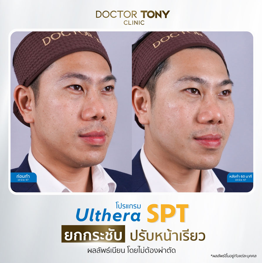 รีวิว ulthera 28