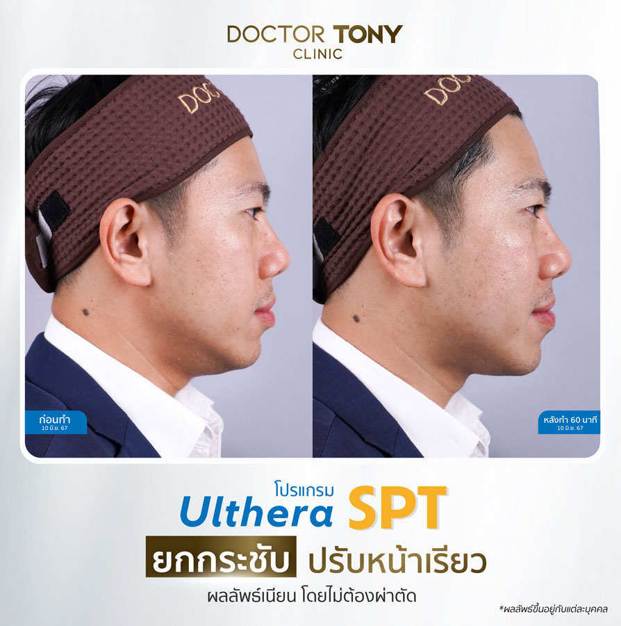 รีวิว ulthera 29