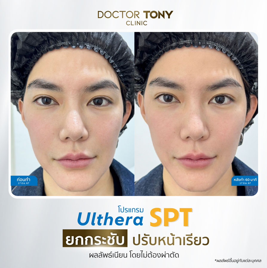 รีวิว ulthera 30