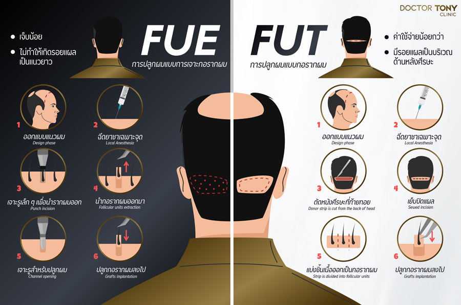 ปลูกผมถาวร FUE