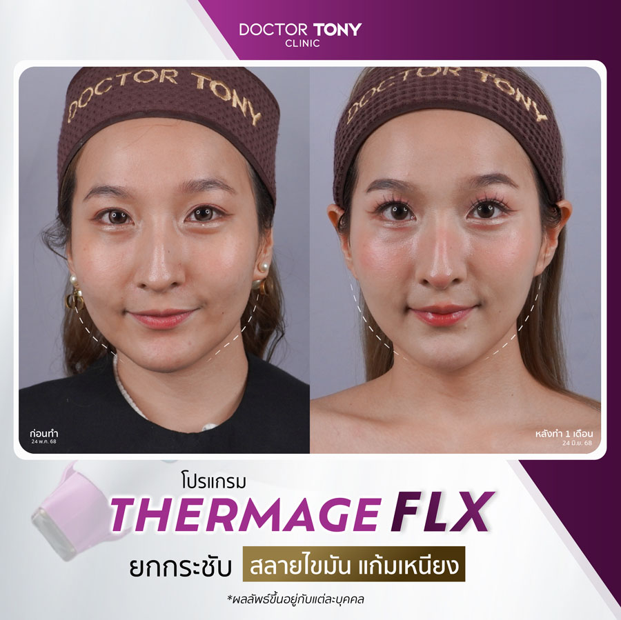 รีวิว thermage 1