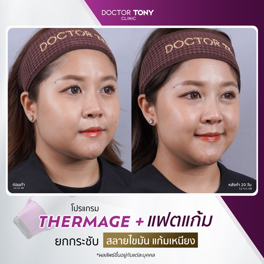 รีวิว thermage 5