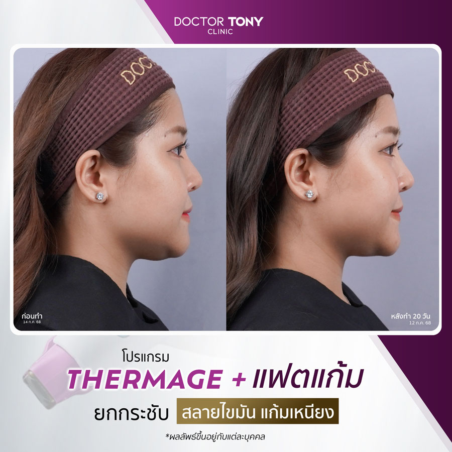 รีวิว thermage 6