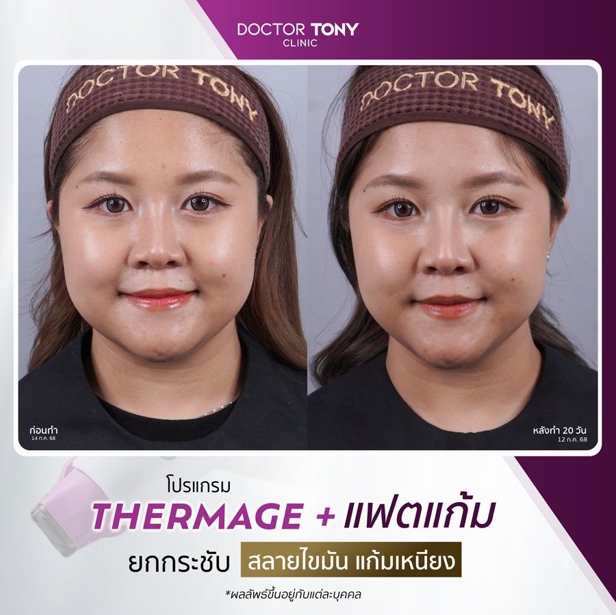 รีวิว thermage 7