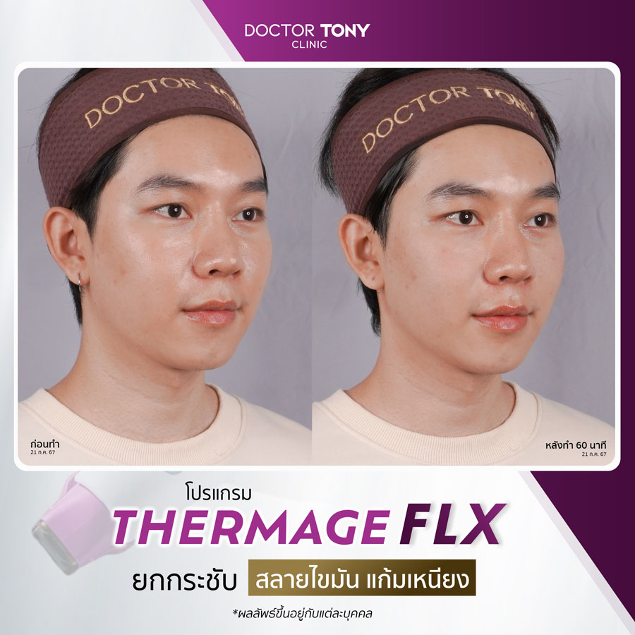 รีวิว thermage 10
