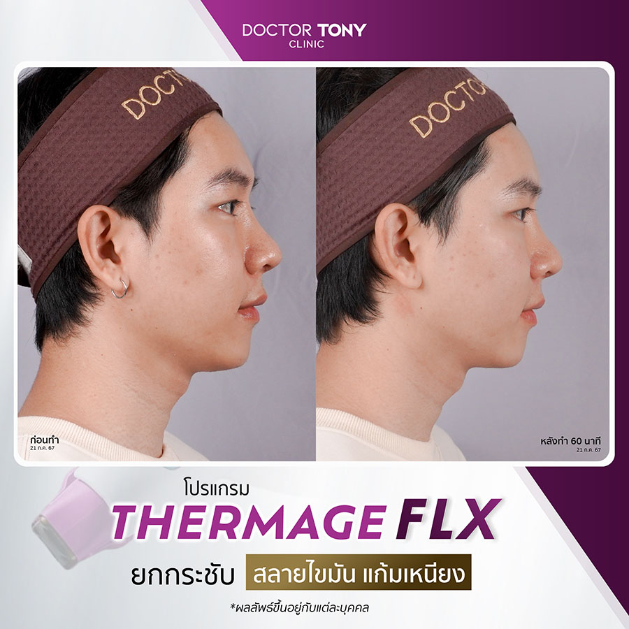 รีวิว thermage 11