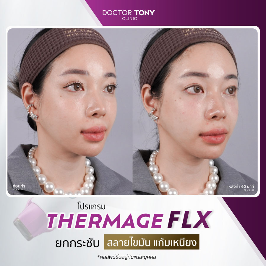 รีวิว thermage 12