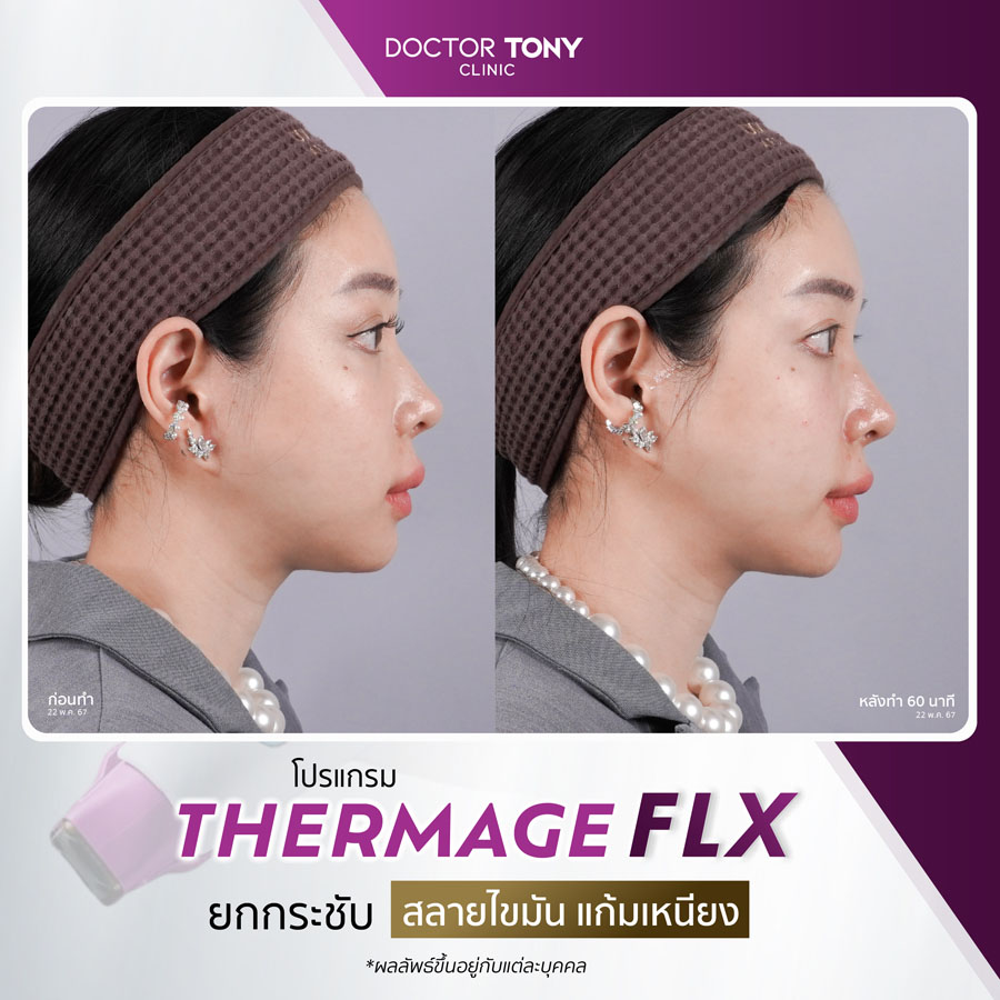 รีวิว thermage 13