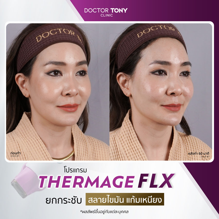 รีวิว thermage 14