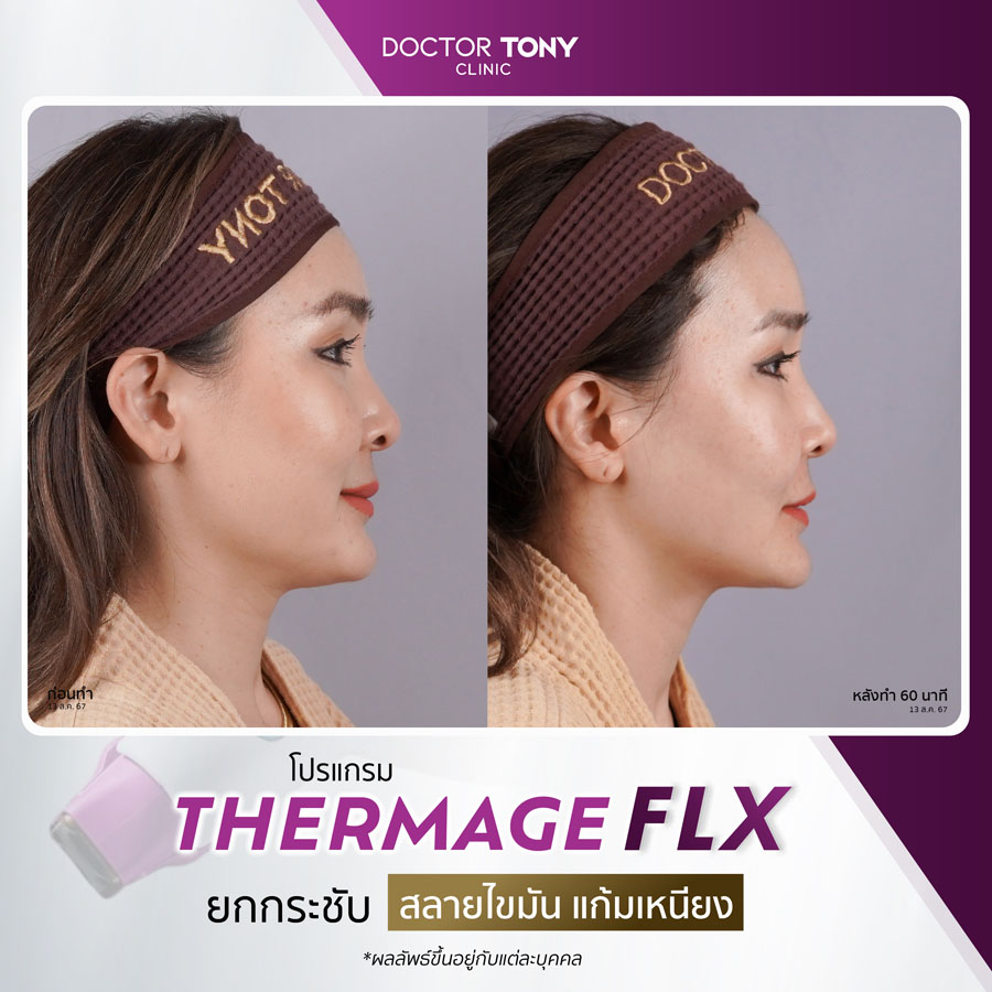รีวิว thermage 15