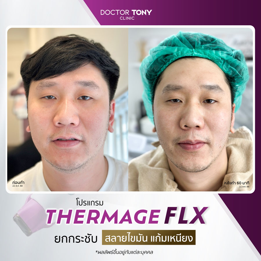 รีวิว thermage 16