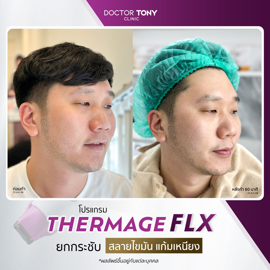 รีวิว thermage 17