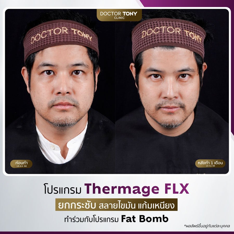 รีวิว thermage 19