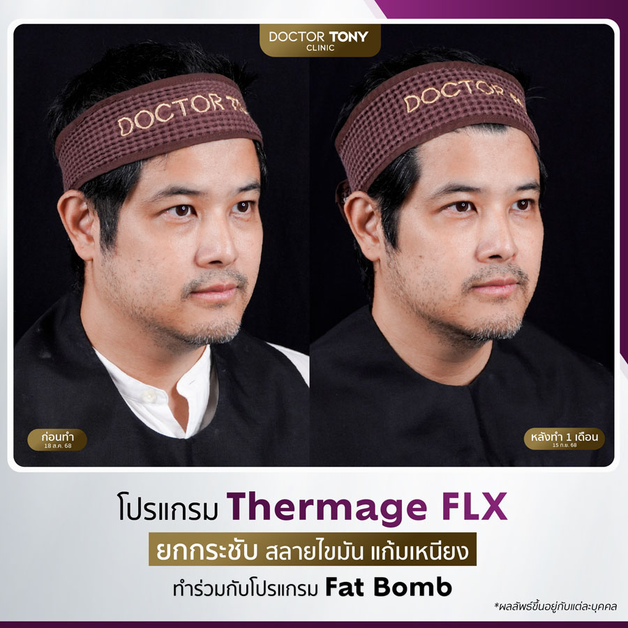 รีวิว thermage 20