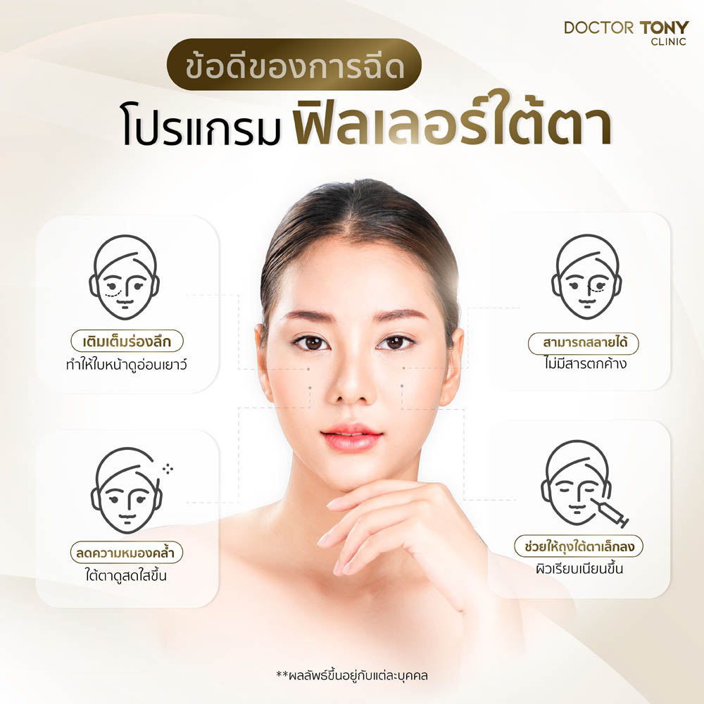 ข้อดีของการฉีดฟิลเลอร์ใต้ตา