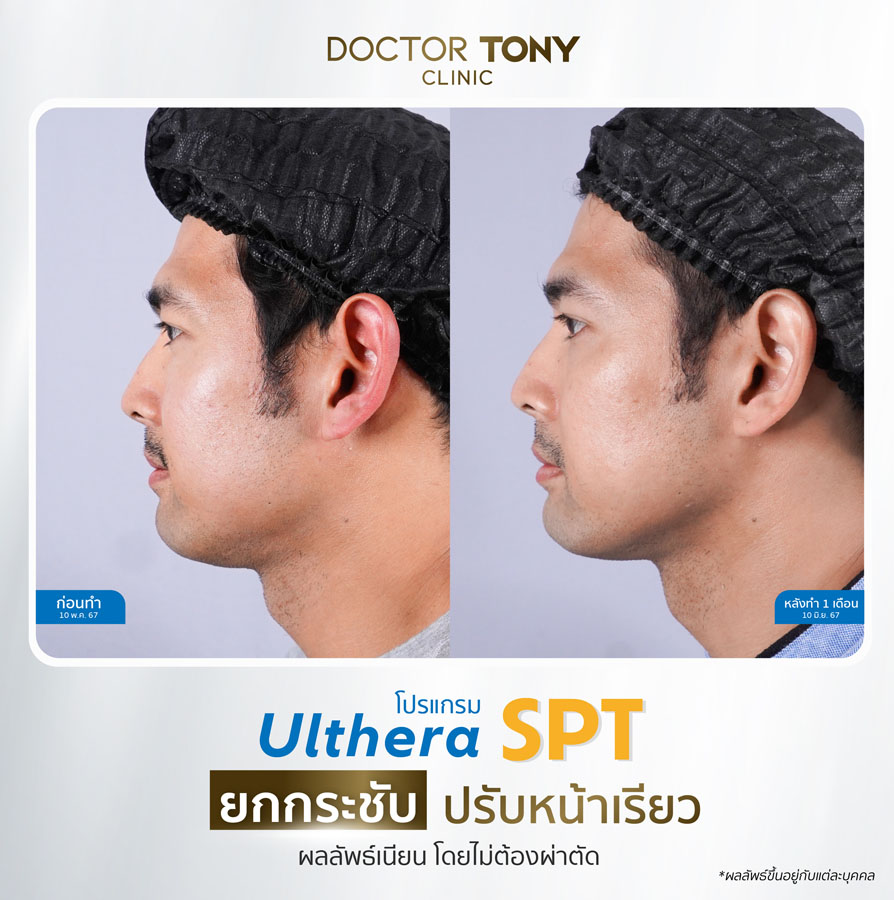 รีวิว ulthera 26