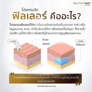 ฟิลเลอร์คืออะไร