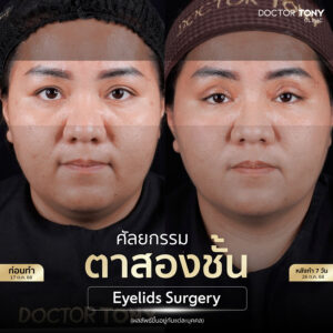 รีวิว ทำตาสองชั้น