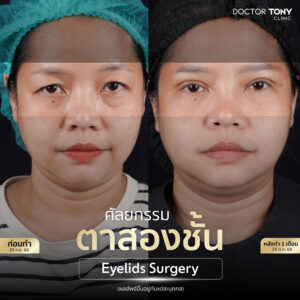 รีวิว ทำตาสองชั้น1