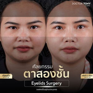 รีวิว ทำตาสองชั้น2