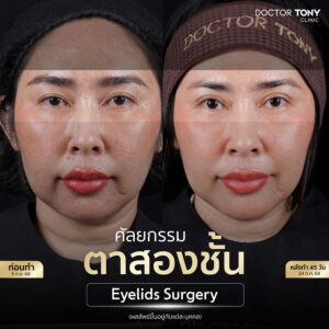 รีวิว ทำตาสองชั้น3