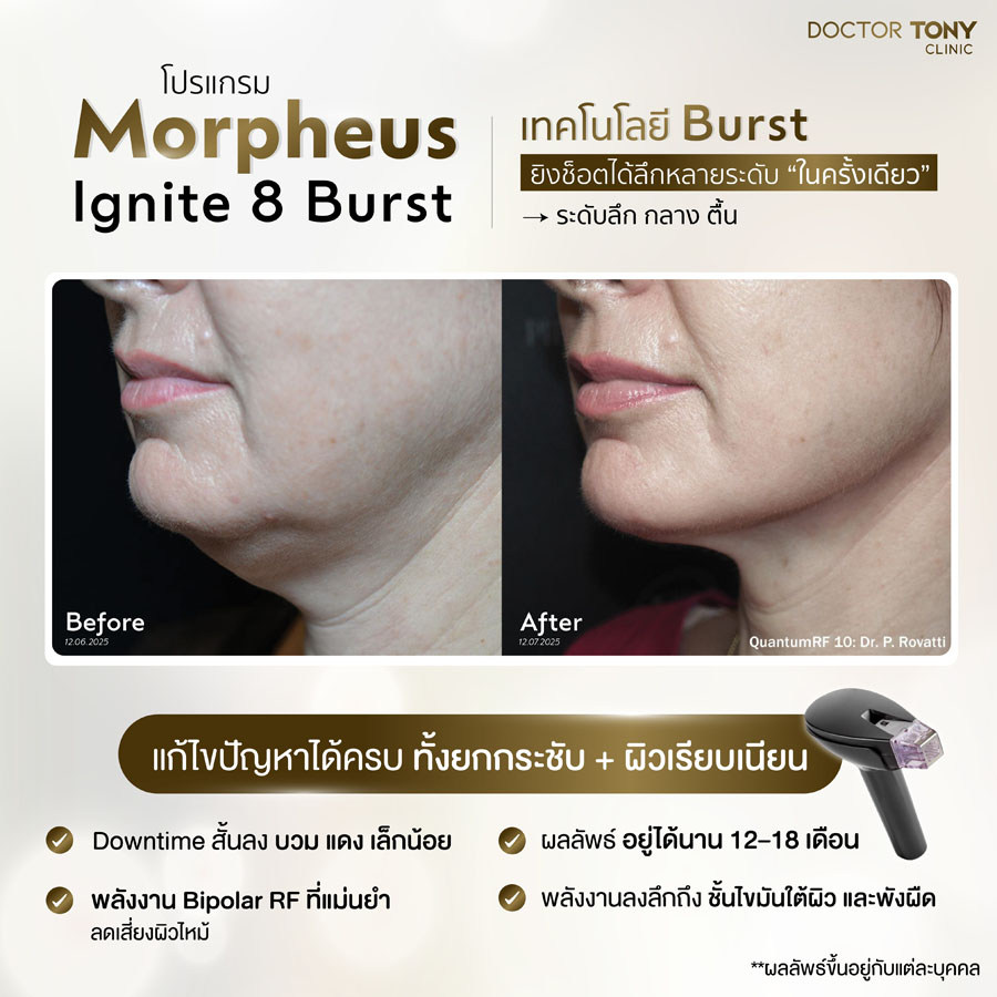 รีวิว Morpheus ignite 21