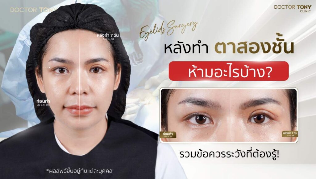 หลังทำตาสองชั้น ห้ามอะไรบ้าง