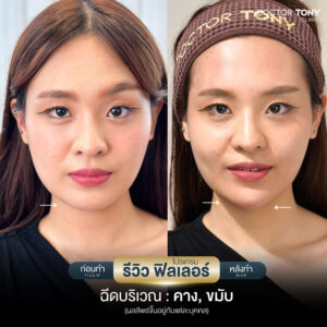 รีวิว ฟิลเลอร์คาง