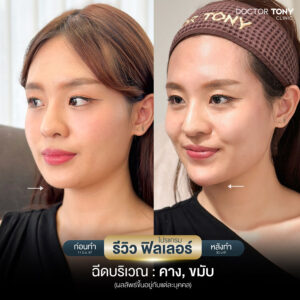 รีวิว ฟิลเลอร์คาง 1