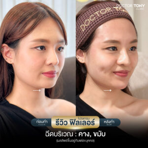 รีวิว ฟิลเลอร์คาง 2