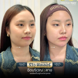 รีวิว ฟิลเลอร์คาง 4