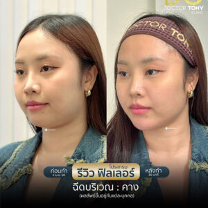 รีวิว ฟิลเลอร์คาง 5