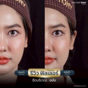 รีวิว ฟิลเลอร์ขมับ 2