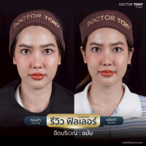 รีวิว ฟิลเลอร์ขมับ 3