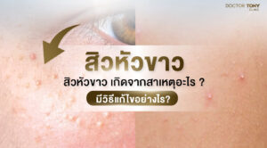 สิวหัวขาว