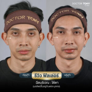 รีวิว ฟิลเลอร์ใต้ตา 32