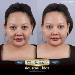 รีวิว ฟิลเลอร์ใต้ตา 31