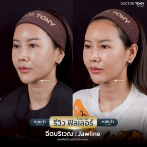 ฟิลเลอร์คาง รีวิว 2