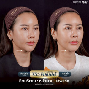 ฟิลเลอร์คาง รีวิว 1