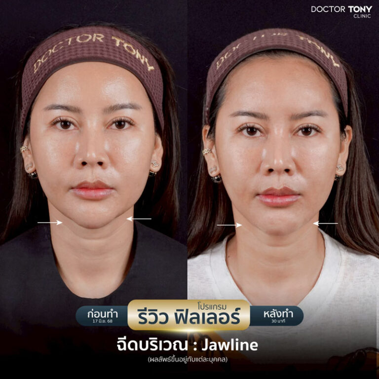 ฟิลเลอร์คาง รีวิว