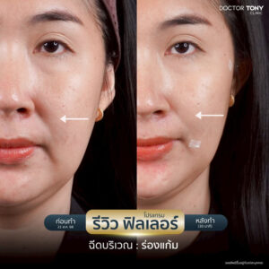 รีวิว ฟิลเลอร์ร่องแก้ม