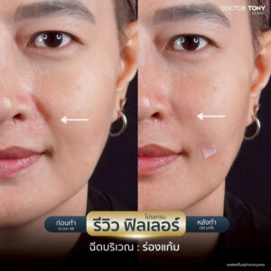 รีวิว ฟิลเลอร์ร่องแก้ม 1