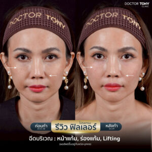 รีวิว ฟิลเลอร์ร่องแก้ม 3