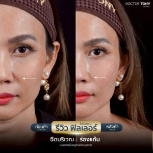 รีวิว ฟิลเลอร์ร่องแก้ม 4