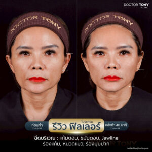 รีวิว ฟิลเลอร์ขมับ 5