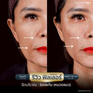 รีวิว ฟิลเลอร์ร่องแก้ม 6