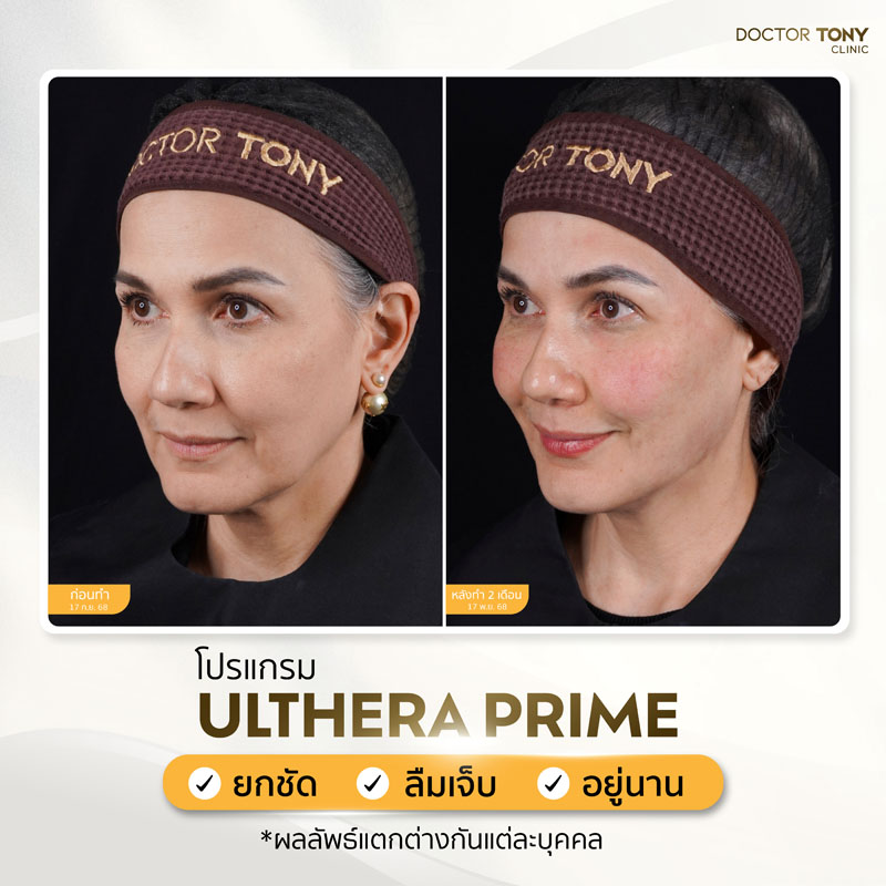 ulthera prime รีวิว 3