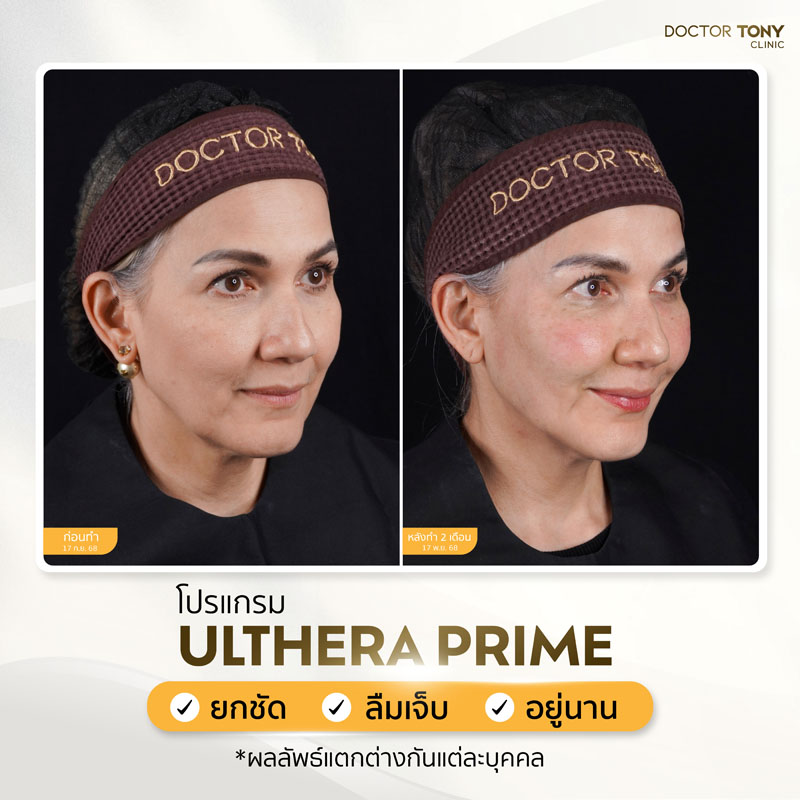 ulthera prime รีวิว 2