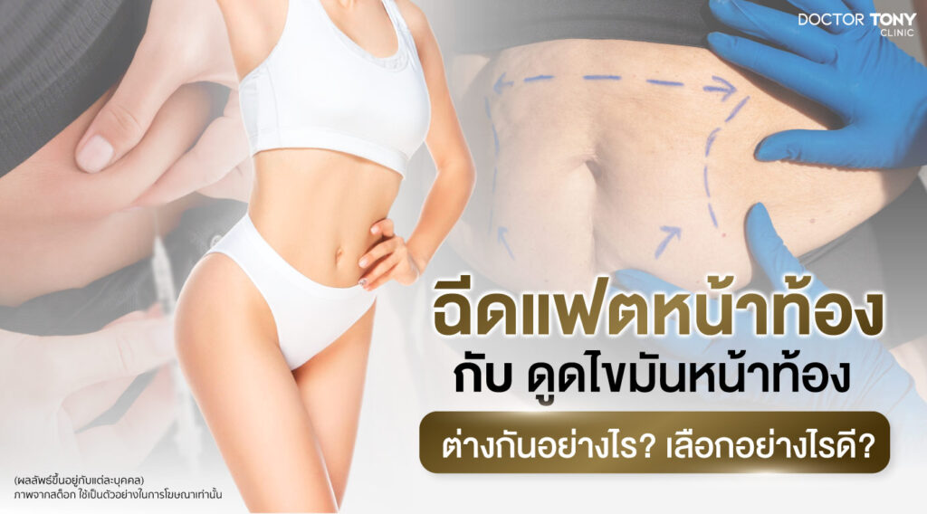 ฉีดสลายไขมันหน้าท้อง